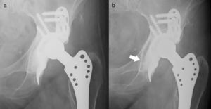 (a) Radiological controls for patient no. 50 immediately post-operative, without graft apposition/Gie I. (b) X-ray one year after surgery, sub-total graft apposition Gie III.