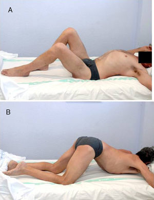 (A) 49-Year old patient with an ASIA B spinal cord injury following a traffic accident 8 years ago. Place in supine position, he presents ankylosis secondary to periarticular ossification (PHO) of both hips. The right hip displays greater involvement, with 85° flexion that limits his sitting in a wheelchair. (B) In the prone position, we can see ankylosis in both hips.