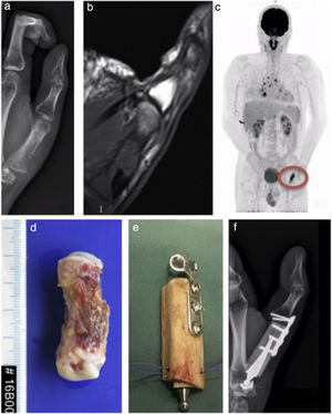 Plain X-ray (a) and MRI (b) and PET (c) scans of a unique metastasis of lung adenocarcinoma in the first metacarpal, in a 35-year-old male, with no known primary prior to the diagnosis of metastasis, treated by en bloc resection (d) and reconstruction with autograft of the fibula (e and f). Two months afterwards the functionality of the hand is practically normal.