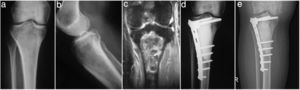 Plain anteroposterior and lateral X-ray (a and b) and MRI (c) of a bone metastasis in the tibia, in a women of 45 years with breast cancer with multiple bone metastasis, treated with curettage, cryosurgery, cement fill and plate stabilisation (d); (e) 10 years after surgery the patient is able to undertake all her daily activities without outside help.