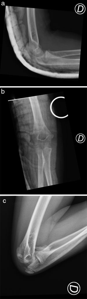 a and b: Lateral and AP X-ray of the elbow after second reduction showing the normal congruency of the joint surfaces; c: lateral X-ray with the elbow flexed at 11 months of follow-up where a voluminous heterotopic ossification in the anterior surface of the ulnar is apparent.