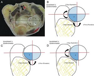 (A) Transversal proximal slice of a right elbow, showing the proximal radiocubital joint and the association with neurovascular structures. (B) Location of the posteromedial quadrant (2) in neutral position respecting the lesser sigmoid cavity. Quadrant 2 is very difficult to reach due to the lesser sigmoid cavity that hinders its exposure. (C) The forearm has to be in maximum pronation to access the quadrant. (D) Quadrant 2 is inaccessible when the forearm is in supination and in neutral position.