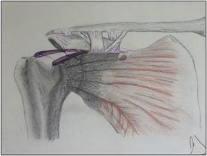 Drawing of the superior capsule reconstruction with hamstring allograft.