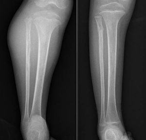 Ewing sarcoma of the proximal fibula. The image on the left shows the large soft tissue component associated with the tumour. A pathological fracture can be seen on the right that occurred during neoadjuvant chemotherapy.