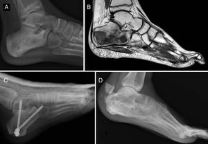 Ewing sarcoma of the calcaneus, conventional radiology images (A) and MR (B). Treated by resection and reconstruction with allograft (C). Radiography after 6 years’ progression (D) showing calcaneus-talus and calcaneus-cuboid consolidated arthrodesis and avulsion fraction of the posterior tuberosity which occurred in the first year, and was treated conservatively because it caused no functional impairment.