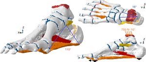 Model proposed to evaluate the effect of calcaneal osteotomy on the passive tissues responsible for supporting the plantar arch.