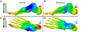 Maximum deformation obtained on simulating the model maintaining bone structure and cartilage alone. The architecture and geometry of the foot collapses under load in the absence of ligamentous structures. Medialising osteotomy limits this effect and makes the arch more stable. A and B: Costa Bartani angle values; C and D: Kite's angle values.