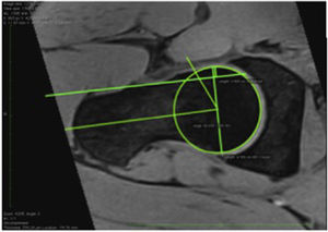 MRI with oblique axial reconstruction showing cam-type FAI, determined by an alpha angle of 66.6° in an asymptomatic participant.