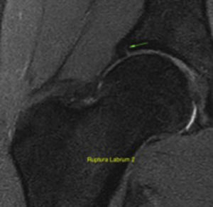 Coronal MRI showing a labral tear in an asymptomatic participant (green arrow).