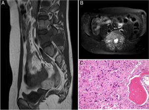 Patient B. (A, B) Preoperative MRI. Tomita V. Enneking IIB. WBB ABCD 8–3. (C) Areas of chondral differentiation with chondral nidi with binucleations and cytological atypia and densely cellular that alternate with host bone tissue and other areas showing bone trabeculae of reactive appearance. There are a large proportion of the cylinders that no longer show bone trabeculae, which have now disappeared destroyed by the atypical cellular proliferation in addition to the presence of osteoid, mitoses, some of which are atypical, and obvious pleomorphism. Compatible with osteosarcoma.