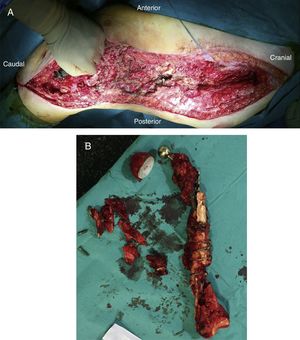 (A) Surgical bed after resection of the implant and remains of femur. (B) Specimen after the resection.