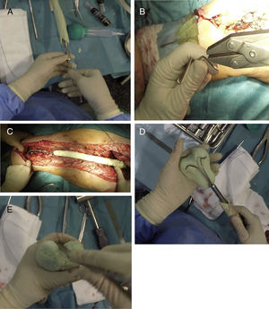 Sequence for creating the distal area of the spacer. (A) Inserting the Rush nails inside the femoral nail. (B) Curving the nails to serve as a “skeleton” for the distal joint. (C) Presentation prior to creating the distal area to “fine-tune” the length of the spacer. (D) Coverage of the Rush nails with antibiotic-laden cement attempting to achieve the shape of a distal femur. (E) Finish of the distal area, placing special emphasis on the trochlea and the femoral condyles.