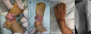 (A) Opening the carpal joint and preparing the centralisation of the carpus in the distal end of the cubitus, showing the carpi ulnaris (CU) with a black arrow. (B) The carpus capsuloligamentary tissues have been sutured, the CU has been shortened and the radial extensor has been transferred to the CU. (C) Final immediate clinical and radiological result.