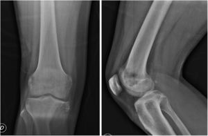Plain X-rays. An eccentric medial meta-epiphysis lytic lesion in the proximal tibia was determined, with extension to soft tissues.