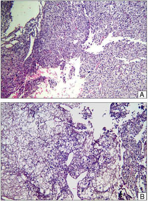 Histopathological slice. (A) Layers of epitheloid cells with predominantly granular cytoplasm are observed, a central hyperchromatic nucleus and prominent nucleolus around the vascular spaces. Areas of haemorrhaging. Haematoxylin–Eosin ×20. (B) Layers of epitheloid cells of clear cytoplasm and in some cases vacuolated cells were observed with a central hyperchromatic nucleus, around vascular spaces. Haematoxylin–Eosin ×40.