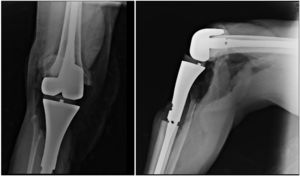 X-ray immediately after surgery. Megaprothesis in knee.