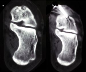 Case 4. Coronal CT (a) of the hindfoot showing the nidus in the neck of talus, in a subperiosteal location, and CT-guided thermoablation (b).