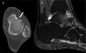 Case 5: axial slice of CT (a) Sagittal MRI T-2 weighted sequence (b). The CT shows the nidus with central calcification (arrow), and the MRI shows the nidus, oedema of the talus and tibiotarsal synovitis.