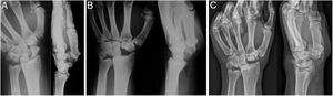 Forty-seven year old male diagnosed with necrosis of the scaphoid bone in the left wrist that underwent resection of the first carpal row. (A) Pre-operative AP-L X-ray of the wrist. (B) Control at 6 weeks following surgery. (C) Control after 16 years of follow up that displays degenerative changes in the radio-capitate joint that cause no clinical symptoms or loss of strength.