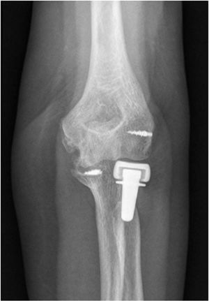 Postoperative imaging of repair using radial head arthroplasty, repair with harpoon of the joint capsule and repair with the harpoon of the lateral collateral ligament.