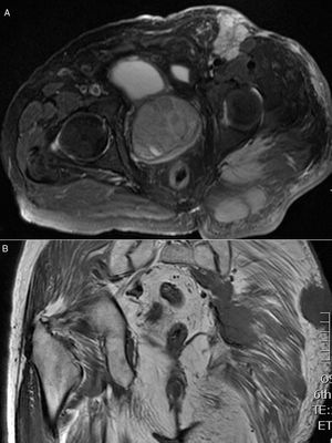 (A) Axial cut of MRI. (B) Coronal cut of MRI.