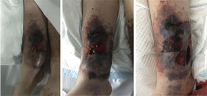 Broad cutaneous necrosis in the medial leg as a result of an untreated tension haematoma.