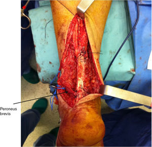 Intraoperative image. Partial transposition of the peroneus brevis and additional rotation plasty. We achieve Achilles tendon continuity and reinforcement with a portion of peroneus brevis.
