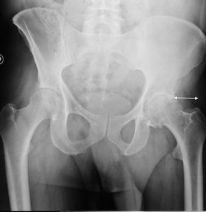 Comparative cohort study of the SuperPath approach and the conventional ...