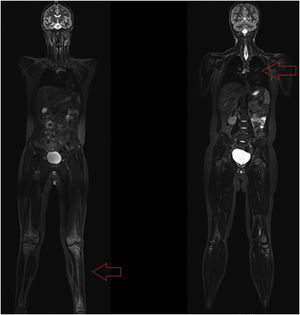 Whole-body MRI after bone puncture which shows left tibial lesions and silent lesions at vertebral level D8.
