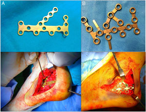 Image A: calcaneal AO plate with non locking pins. Image B: LCP plate with locking pins.