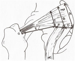 Anthropometric measurements. A: extension of the piriformis muscle in its origin. B and C: extension of the piriformis muscle at medial and lateral level of the sciatic nerve exit. D: distance between the origin of the piriformis muscle and the exit of the sciatic nerve. E: distance between the sciatic nerve and the greater trochanter of the femur. F: diameter of the sciatic nerve at its exit. G: diameter of the piriformis muscle of the tendon prior to insertion. PM: piriformis muscle; SN: sciatic nerve.