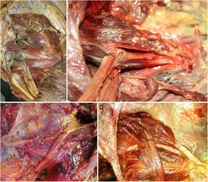 A) Normal anatomy of the gluteal region. Injected gluteal blood vessels. Corresponds to type I anatomical variation. B) Type II anatomical variation. Common peroneal nerve crossing piriformis muscle. C) Type II anatomical variation. D) Type II anatomical variation (left and right). In the figure on the right we observe 2 muscle heads of the piriformis muscle. The lower one has a tendinous origin. GM: gluteus medius; PM: piriformis muscle; SN: sciatic nerve; CPN: common peroneal nerve; TN: tibial nerve; LH: lower head of the piriformis muscle; UH: upper head of the piriformis muscle.