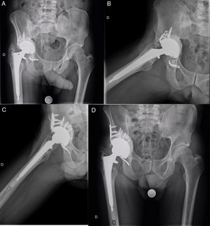 A 40 year-old patient with rheumatoid arthritis in whom total primary hip replacement was implanted in 2003. They later required a cup replacement with a bone graft due to aseptic loosening in 2008. In 2010 they required another cup replacement with bone graft and implantation of a Bat-Cup type reinforcement ring due to aseptic loosening with acetabular protrusion. This also failed in 2012 with implant rupture and aseptic loosening, which was why the Cup-Cage was implanted. Images A and B show the radiographies in anteroposterior and axial projections, respectively, where acetabular loosening with rupture of the ring ischiatic insertion may be observed. Images C and D correspond to radiographic control in the axial and anteroposterior projections 3 and a half years after Cup-Cage implantation, with appropriate integration of the acetabular graft and good implant positioning.