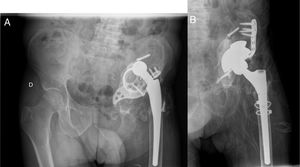 (A) Anteroposterior radiography of a patient who underwent surgery in another centre. Loosening and migration of the acetabular ring is observed. (B) Postoperative radiography after revision with metal trabecular cup with a superior supplement, Cup Cage and bone graft. Correct filling of the acetabular fossa and correct positioning of the implant.