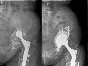 (A) Patient with massive acetabular defect and pelvic discontinuity. (B) An acetabular replacement was made with a metal trabecular cup combined with a bone graft and Cup-Cage.