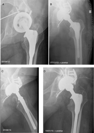 Patient aged 49 years with THR implanted in another hospital 20 years previously, after an accident. (A) Anteroposterior radiograph where shifting of the actabular component is observed, with evidence of pelvic discontinuity due to a pseudo osteoarthritis. (B) Immediate postoperative anteroposterior radiography. (C) Radiographic control after 6 months, with polyethylene decementing. (D) Radiographic control in the immediate postoperative period after the polyethylene replacement.