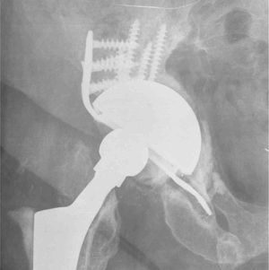 Image of an anteroposterior radiography of the right hip where localised osteolysis may be observed at ischium level.