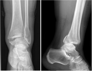 SER IV ankle fracture. Posterior fragment of 9mm and joint surface of 31mm. The posterior edge in this case involves 29% of the joint surface; belonging to group C.