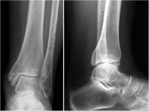 Same patient, 18 months after the SER IV fracture. Note the residual joint step-off and the presence of subchondral sclerosis and anterior tibial osteophyte; with an AOFAS score of 80 points.