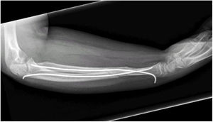 Control X-ray of patient with ulnar and radius fracture treated with embedded intramedullary implants.