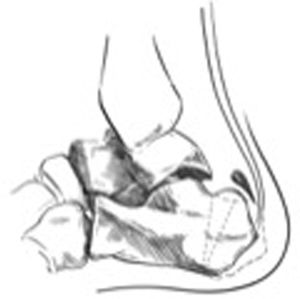 The dotted lines show the dorsal wedge calcaneal osteotomy for the Haglund triad. The purpose of this osteotomy is to elevate the point of insertion of the Achilles tendon and anteriorise posterosuperior tuberosity of the calcaneus. Shortening of the calcaneus and elevation of the point of insertion of the Achilles tendon reduces the pressure on the Achilles tendon insertion.