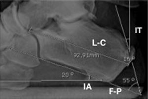 The mean of the inclination angle of the calcaneus (IA) was 21.9°. The mean of the Fowler–Phillips (F–P) angle preoperatively was 53.2° and was reduced after surgery. The length of the calcaneus (L-C) lowered after surgery by a mean of 4.8mm. The tuberosity angle inclination (TI) increased after the osteotomy, because the tuberosity was displaced forward.