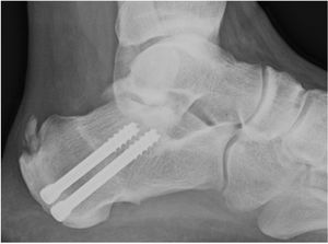 Postoperative X-ray of a dorsal wedge calcaneal osteotomy fixed with 2 6.5mm cannulated screws. It may be observed that calcification usually remained after surgery because the tendon has not been debrided.
