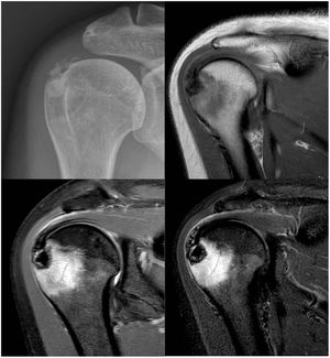 Plain X-ray of the shoulder, anteroposterior projection: a calcification can be observed between the humeral head and the acromion (upper left image). MRI images: calcification of the supraspinatus can be observed with an osteolytic lesion in the greater tuberosity of approximately 1cm in diameter and significant bone oedema of the humeral head of 36×39mm (upper right, lower right and lower left images).