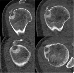 CT images. A lytic cortical lesion dependent on the external side of the humeral head with expansive behaviour can be observed, accompanied by a peripheral osteo-condensing area and peripheral hypodensity in relation to the bony oedema present on the MRI, showing radiological characteristics of local aggressiveness.
