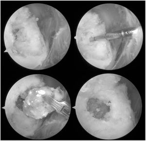 Arthroscopic images where the intraosseous expansion of the calcification can be observed once the intratendinous calcification has been debrided (upper right and upper left images). In the lower left image the removal of a single piece of the intraosseous material can be observed, which corresponds with an elastic tissue sac with calcic deposits. In the lower right image, the bone defect bed can be observed in the greater tuberosity once the lesion had been debrided.