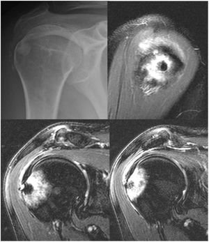 Plain X-ray of the shoulder, anteroposterior projection: a calcified nodular lesion and sclerosis can be observed at the level of the greater tuberosity eroding the cortex as well as small calcifications in the subacromial space (upper left image). MRI images: calcifications are confirmed in the tendon of the supraspinatus and a nodular lesion of 6mm in the greater tuberosity, hypointense in all the sequences, that is eroding the cortex and is associated with major surrounding bone oedema (upper right, lower left and lower right images).
