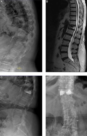 81-year-old female. A) D12 osteoporotic wedge-type fracture with 75% crush and 18° kyphosis (RI group). B) MRI showing oedema in the fractured vertebra (sign of recent fracture). C and D) anteroposterior and lateral radiological projections after bilateral transpedicular vertebroplasty. Good vertebral fill with cement. Cement leak of small dimensions is shown lateral to the right pedicle. The patient experienced improved pain of 5 points on the VAS.