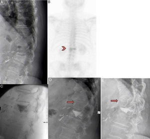 A) 71-year-old female with D12 fracture. B) Had previously undergone abdominal surgery. Bone scan showed hyper-uptake in the fracture after 12 months. C) Patient included in the RI group. Vertebroplasty performed in D12, with cement leaking into the caudal disc. D) Improvement of 4 points on the VAS was observed. One month after the vertebroplasty the patient presented intense back pain after spinal flexion. The x-ray showed a new compression fracture in D11 that was treated conservatively with corset and analgesia. E) After 3 months, the fracture had consolidated with 30% crush. The patient is currently asymptomatic.