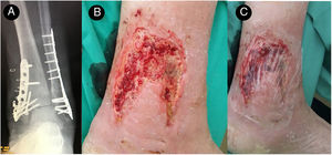 Osteosynthesis (A) and baseline appearance of the wound (B) and plastic cover (C) to inject the liquid sevoflurane.